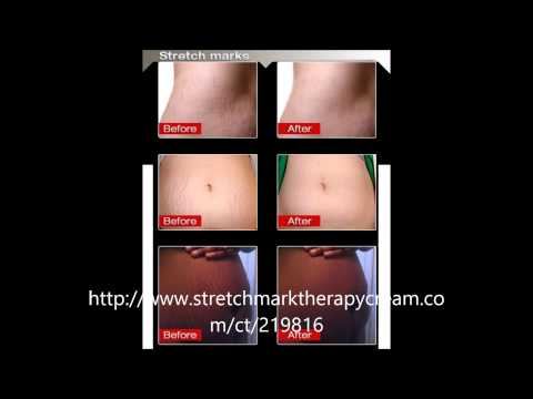 Stretch Mark Therapy