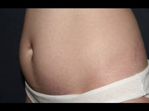How To Get Rid Of Weird Stretch Marks Fast!!!!