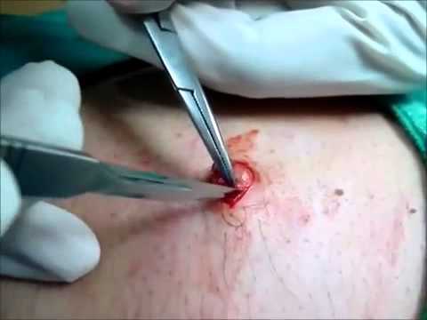 Complete Cyst Removal A Technique To Watch