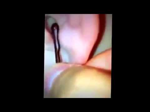 Popping a gross pimple On Ear kopia