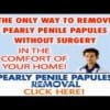 Pearly Penile Papule Removal by Josh Marvin [Pearly Penile Papules Review]