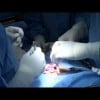 Dramatic Surgery Series  Semi Rigid Penile Prosthesis