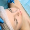 Does Botox prevent migraine? (Conditions AZ)