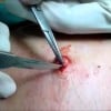 Complete Cyst Removal A Technique To Watch