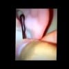 Popping a gross pimple On Ear kopia